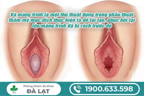 Hình ảnh minh họa